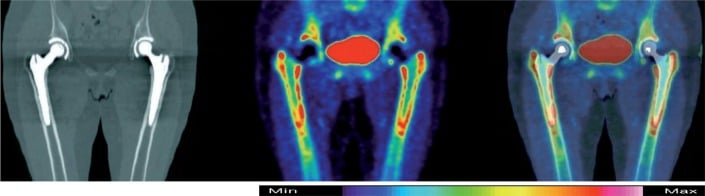 Gösta Ullmark - From left to right CT F PET and combined PET CT images of pelvis and hips 4-months